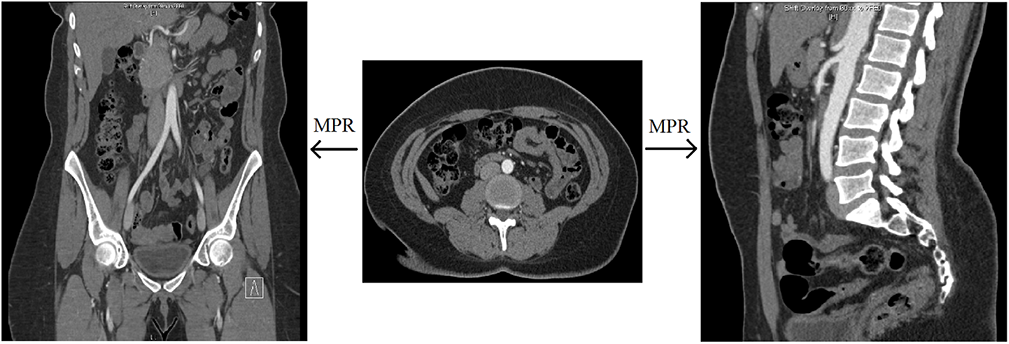 Multiplanar reformat (MPR)