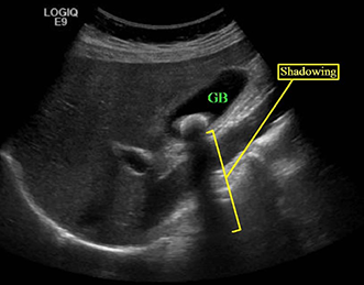 Posterior acoustic enhancement