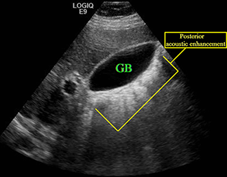 Posterior acoustic enhancement