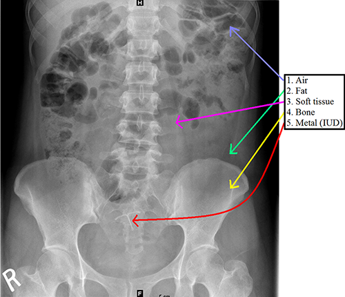 Radiographic Opacities