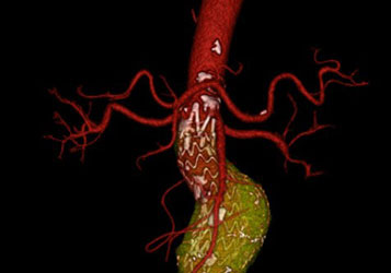 aortic stent 3d recon